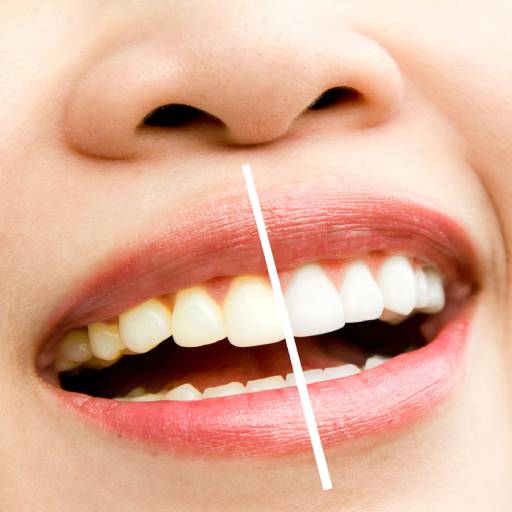 blanqueamiento dental dentista en málaga